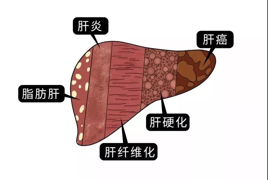 脂肪肝的最大敵人不是肥胖，答案竟是這樣！