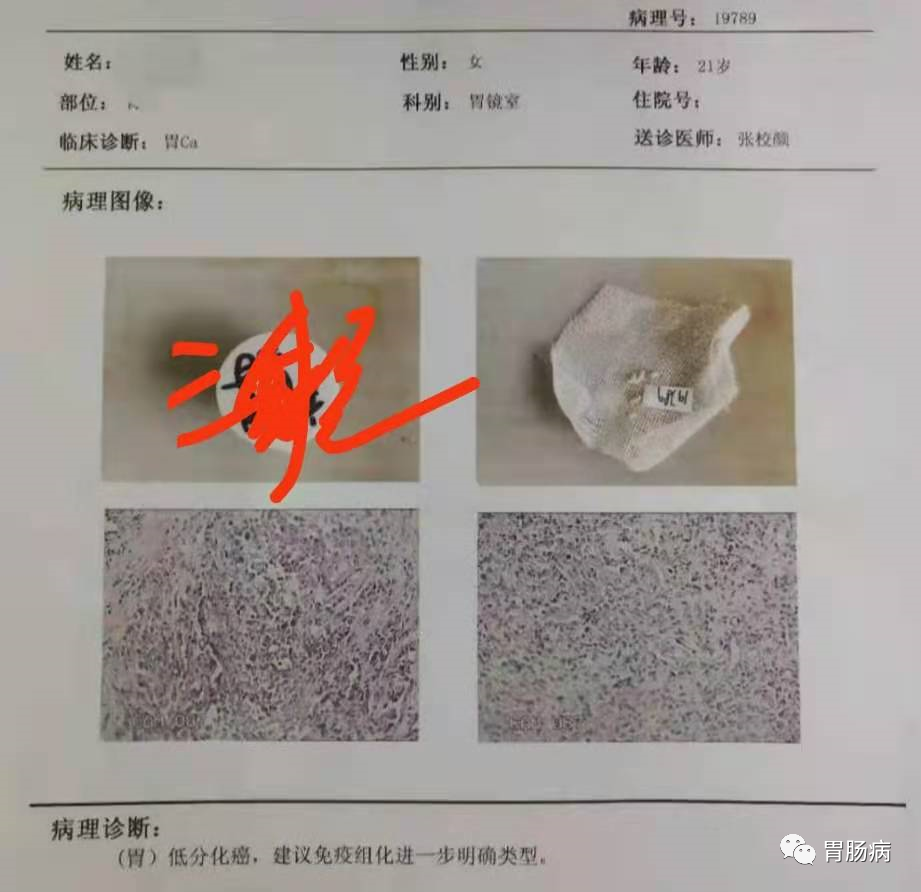 醫(yī)生總結(jié)了3位年輕胃癌患者的病例：30歲不到的他們到底干啥了？