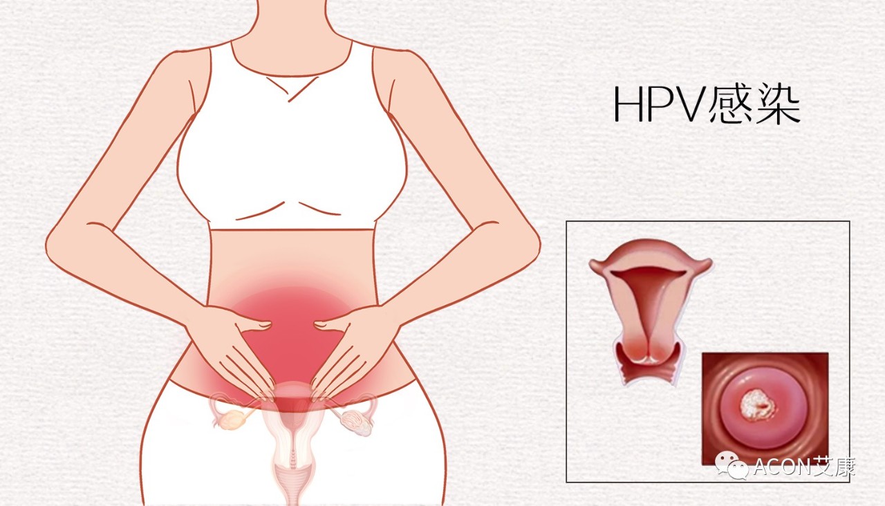 HPV轉(zhuǎn)陰其實(shí)很簡(jiǎn)單， 女性必知的宮頸癌真相