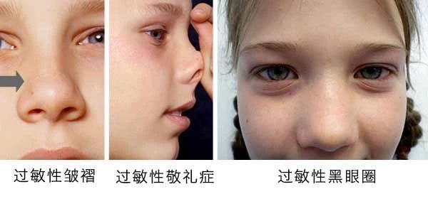 過敏性鼻炎會讓孩子變傻？！家長該如何應(yīng)對